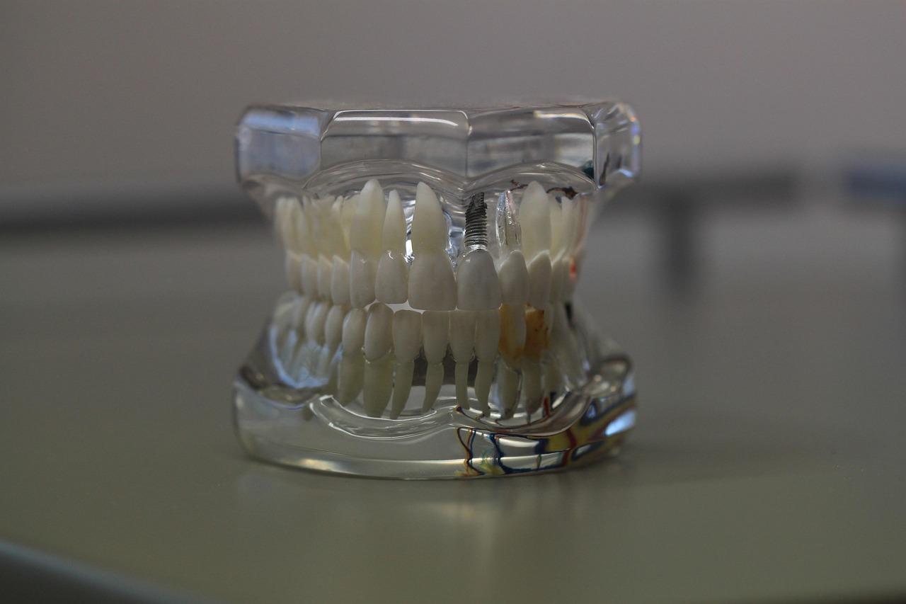 titanium implant abutment dental model
